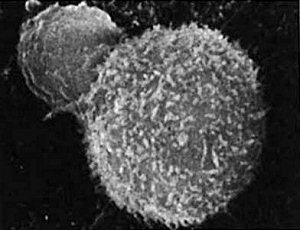 T-cell (small sphere) attacks a cancer cell